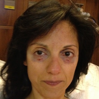 Patient immediately after a mini-blepharoplasty